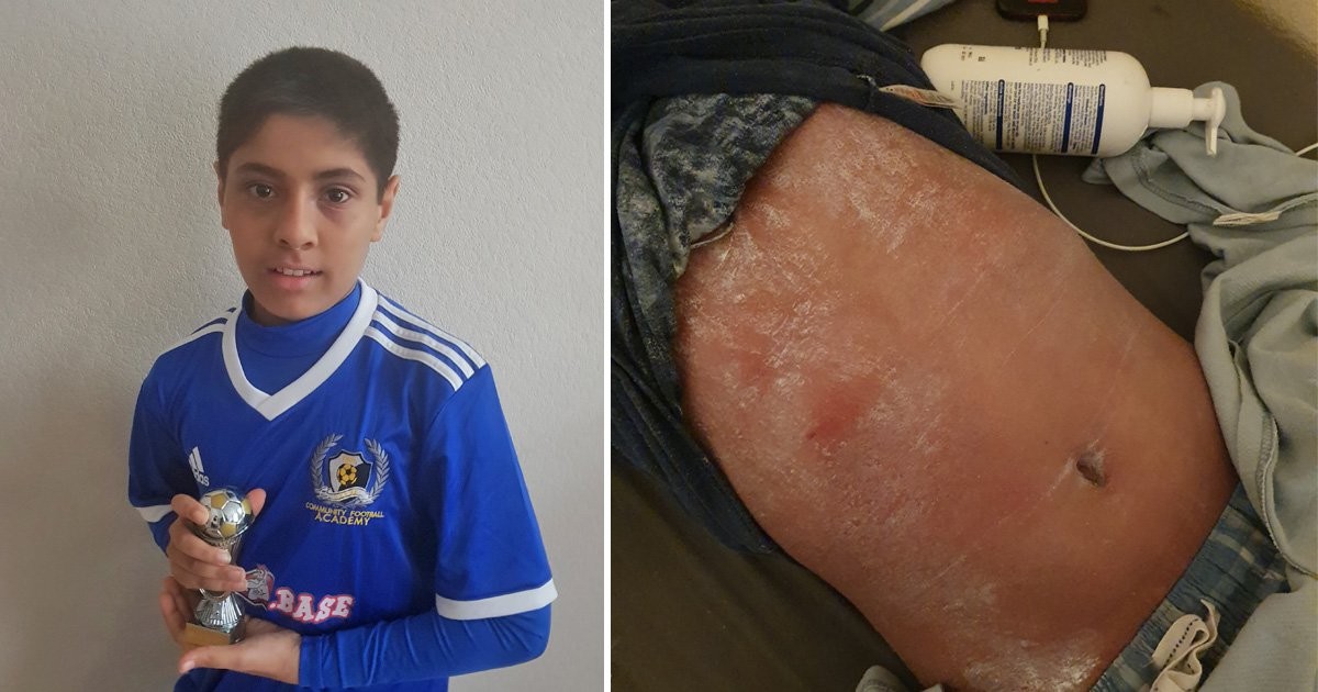 Boy develops severe life-threatening skin condition after having mild eczema as a child