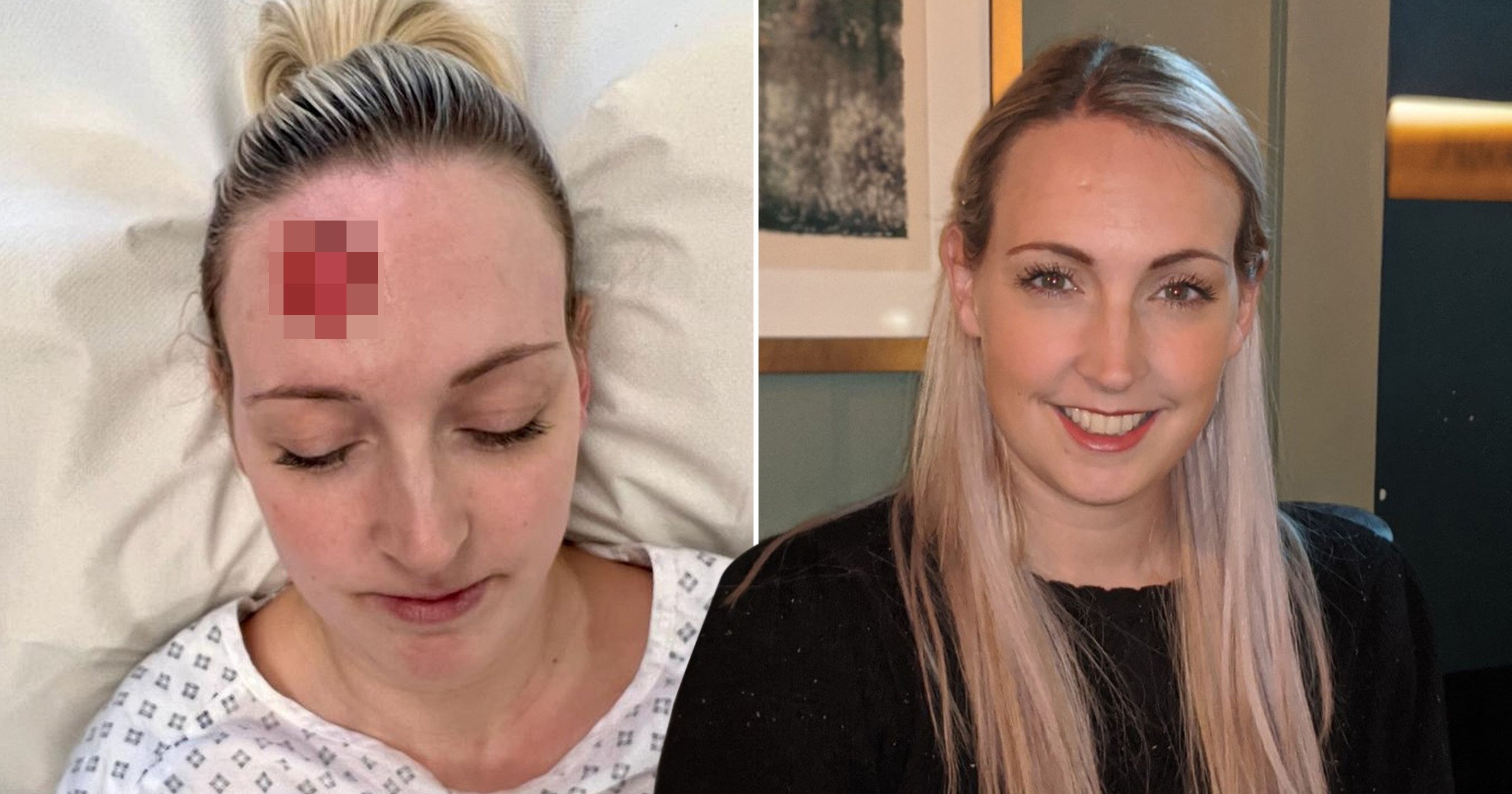 Mum has ‘huge chunk’ of forehead removed after ‘tiny mark’ turned out to be skin cancer