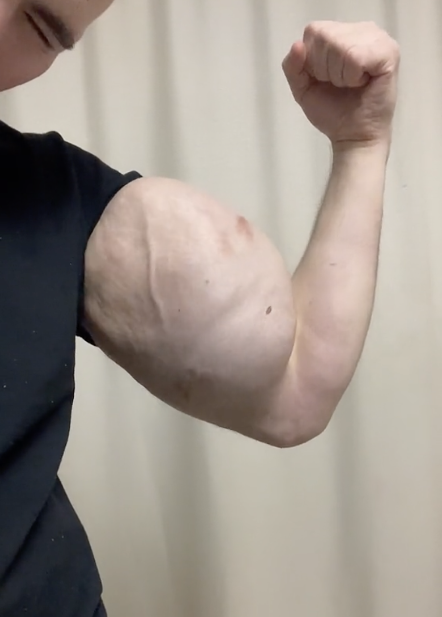 'Russian Popeye' Is Concerning Fans With Footage Of Him Flexing Jelly Injected Arms