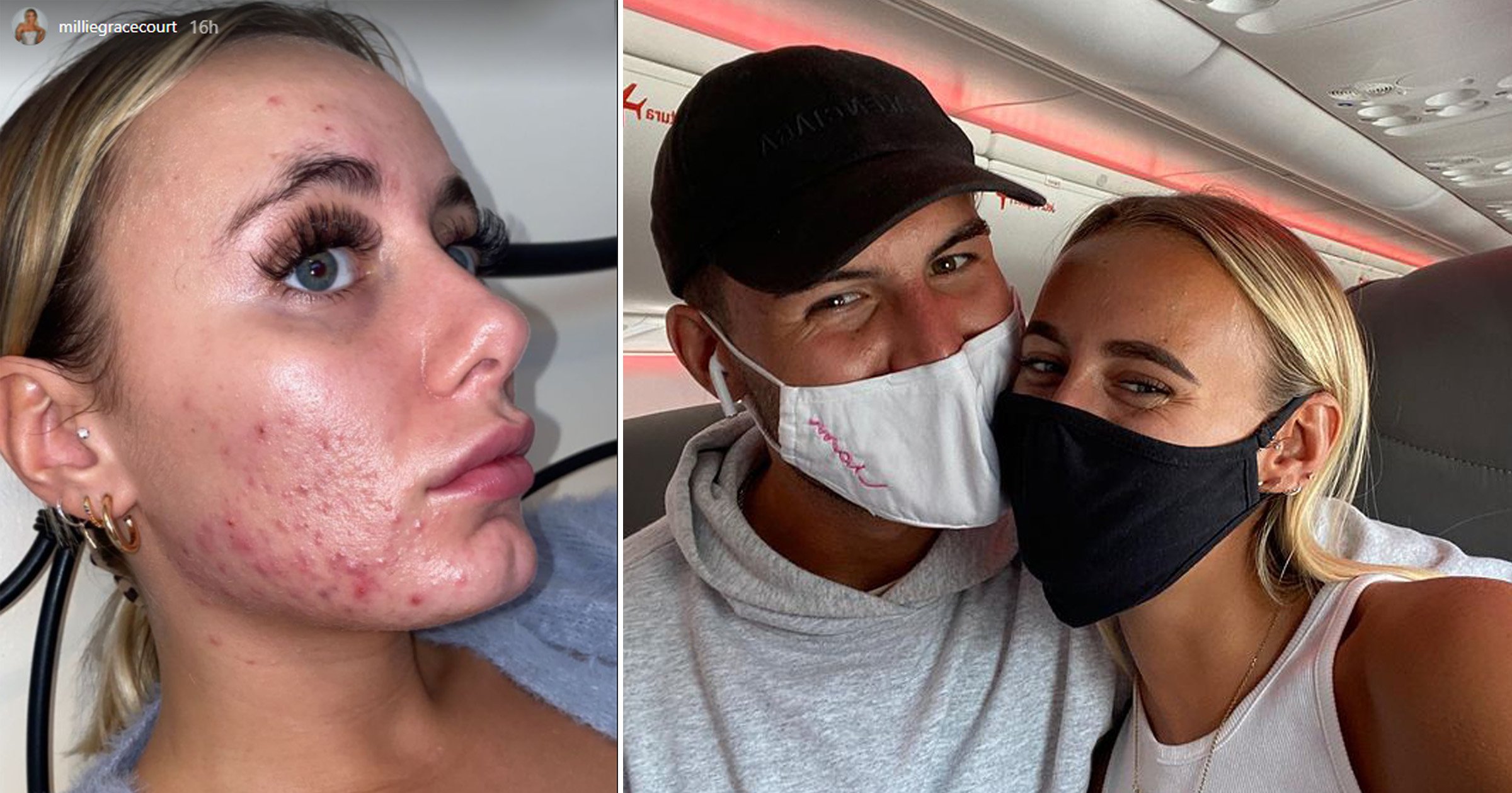 Love Island winner Millie Court so self-conscious over skin condition she hid under mask: ‘That’s how unconfident I was’