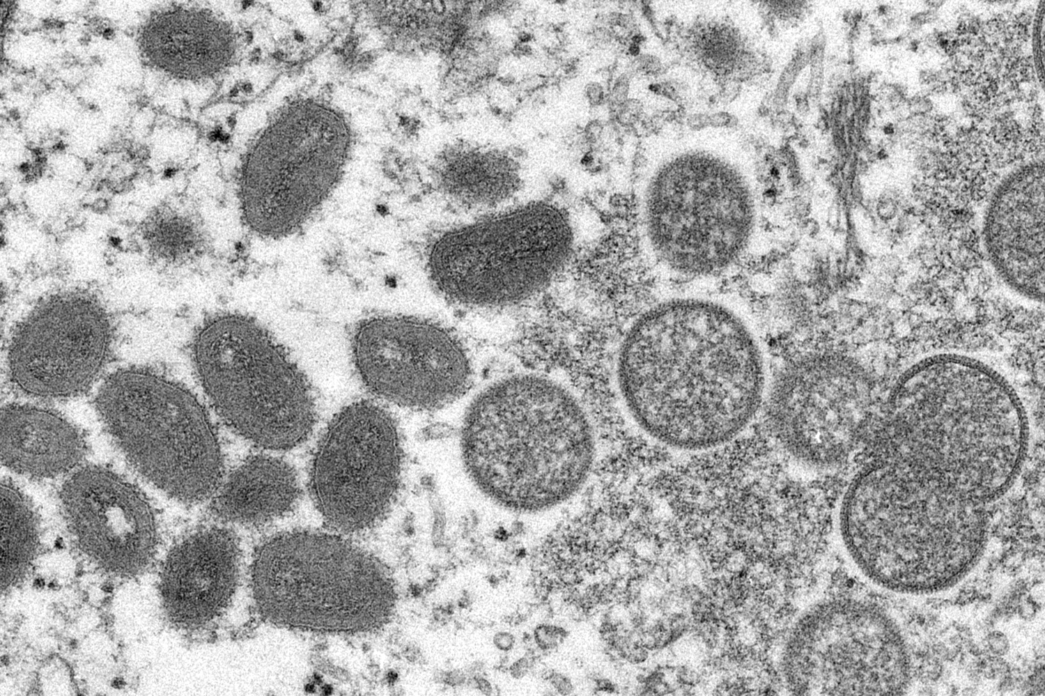 Monkeypox 'Not a Sexually Transmitted Infection' but CDC Warns of Rashes in Genital Area