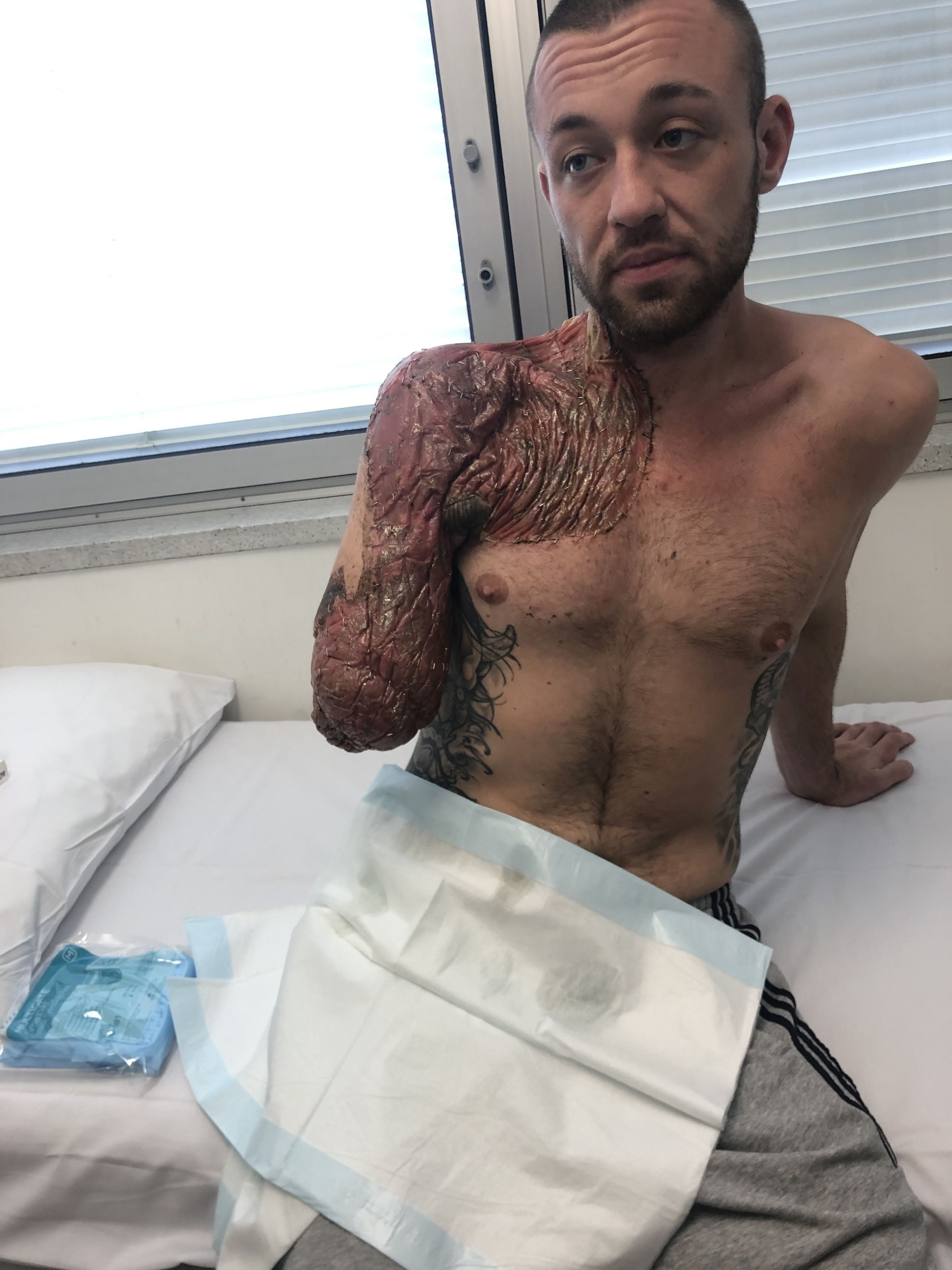 Man's Forearm Amputated After Botched Bicep Curl Left Him With Flesh-Eating Bug