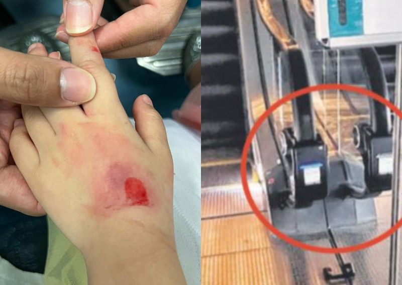 Skin of 5-year-old girl's hand ripped off in escalator incident at Asia Square