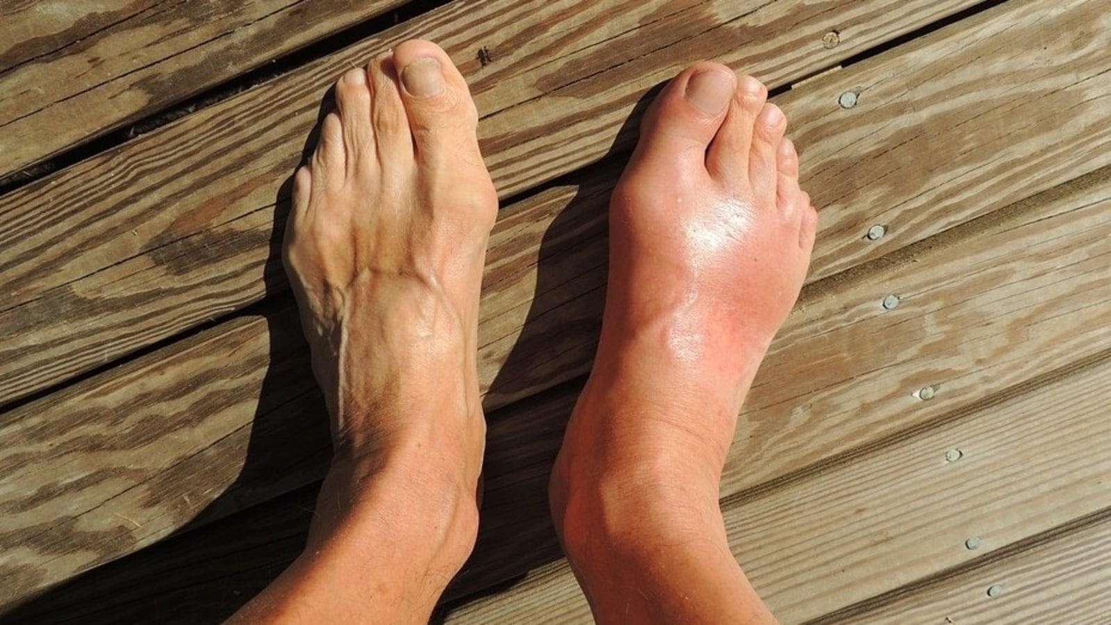 Midfoot arthritis: Warning signs, causes and all you want to know