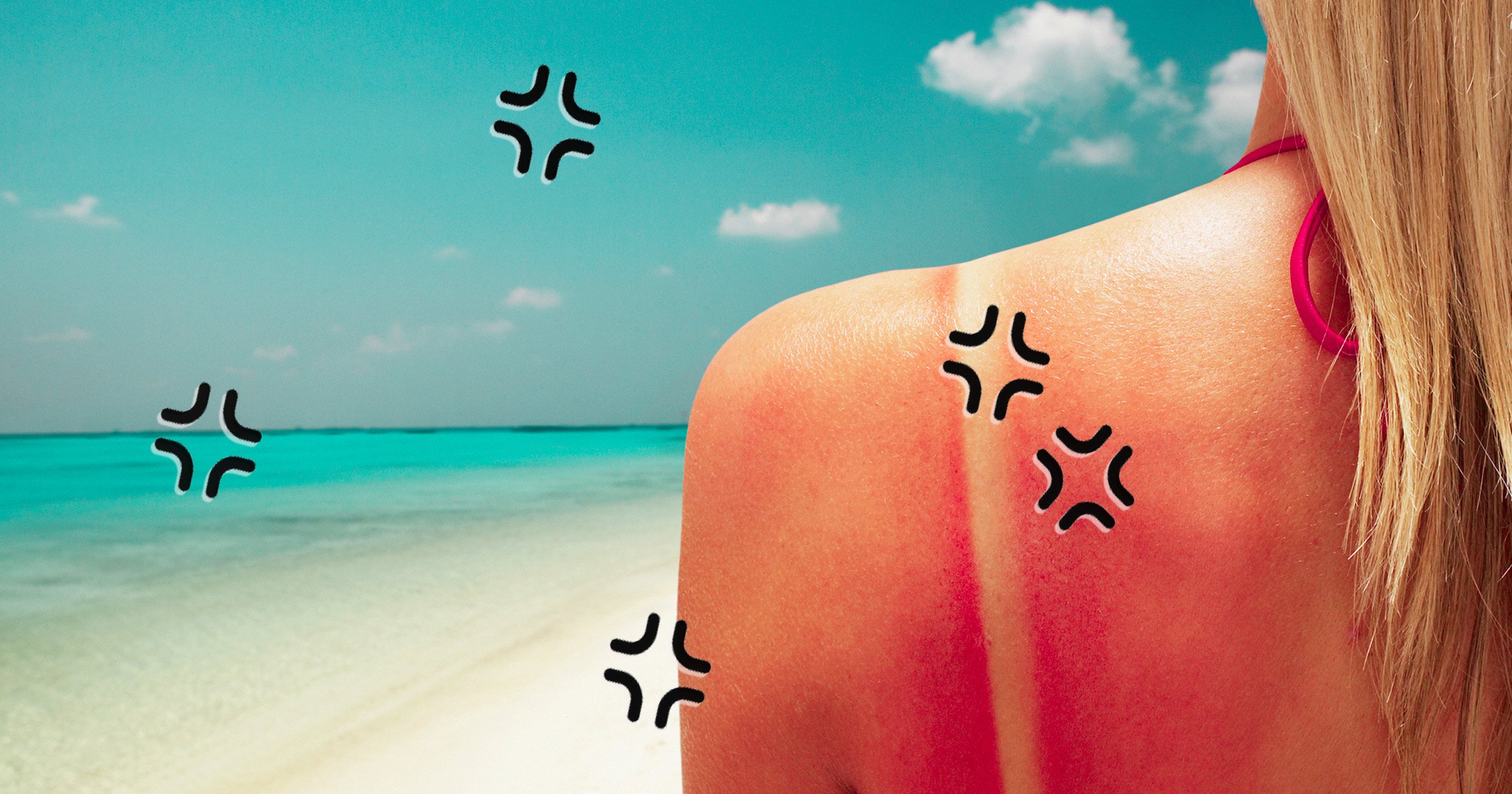 How to stop sunburn from stinging, according to the experts