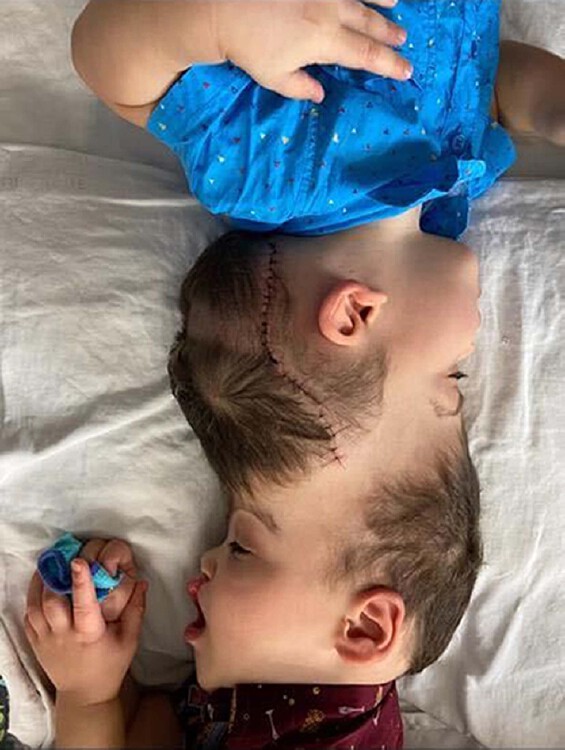 Conjoined Twins With Fused Brains Separated By UK Doctor In 'Remarkable