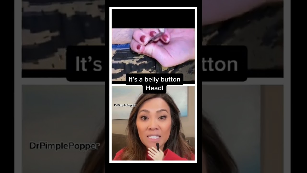 Dr Pimple Popper POPS Belly Button Comedone!