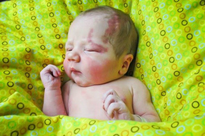 5 common types of birthmarks in babies