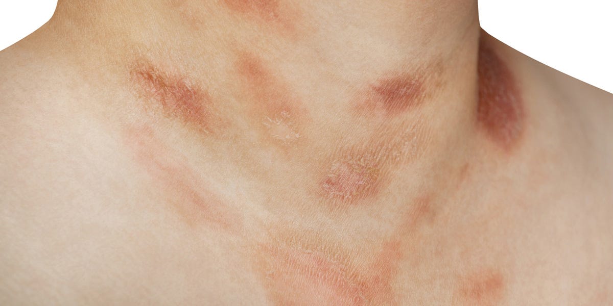 Pityriasis rosea: Signs, causes, diagnosis, treatment