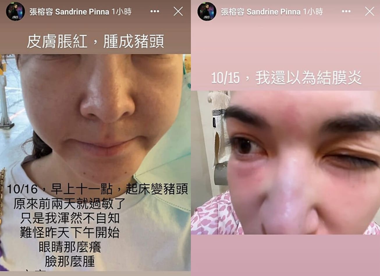 Taiwanese Actress Sandrine Pinna Had An Allergic Reaction So Bad, It Made Her Face Resemble "A Pig's Head"