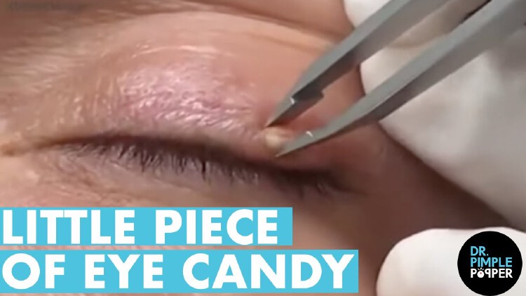 Milium Eye Candy 🍬dr Pimple Popper Satisfies Patients Request Nestia 