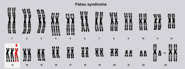 Patau Syndrome: Causes, Symptoms, and Life Expectancy of Diagnosed Babies