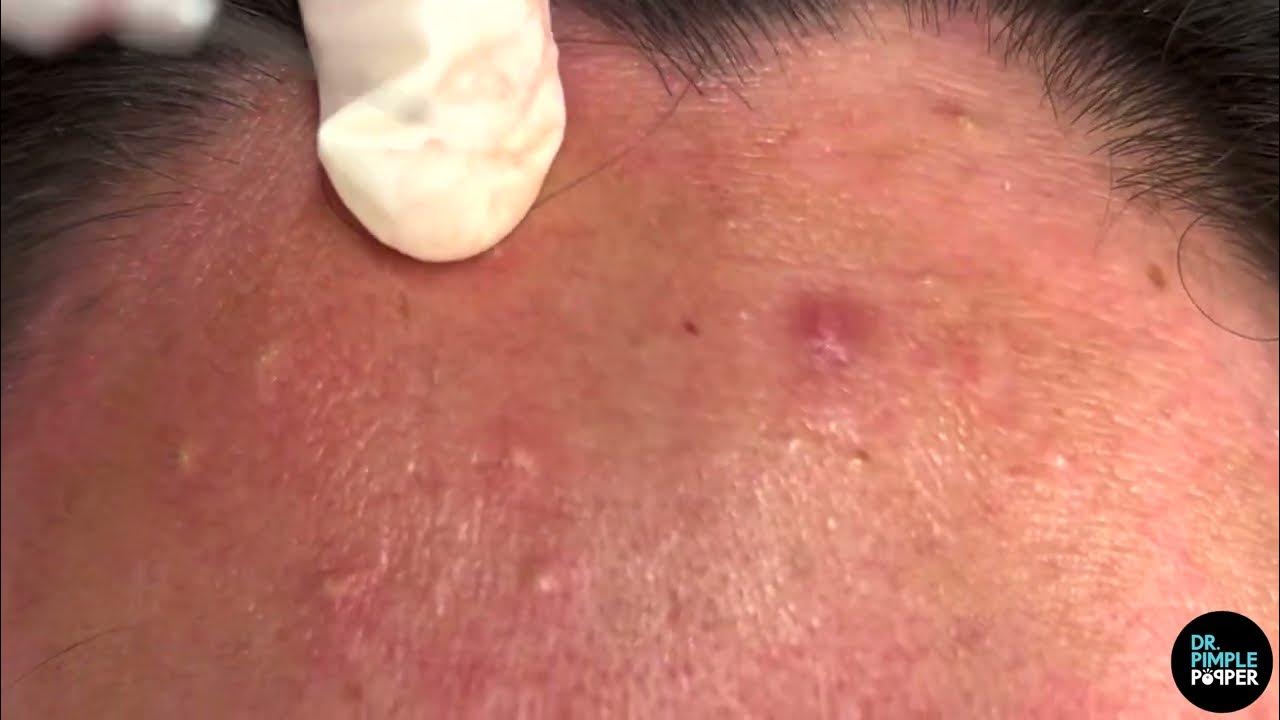 Comedones Galore on Face and Forehead! Dr Pimple Popper Pops & Removes Comedones