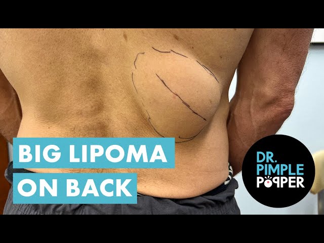 A Back Breaking Lipoma! Great Conversation with Dr Pimple Popper While Removing Lipoma