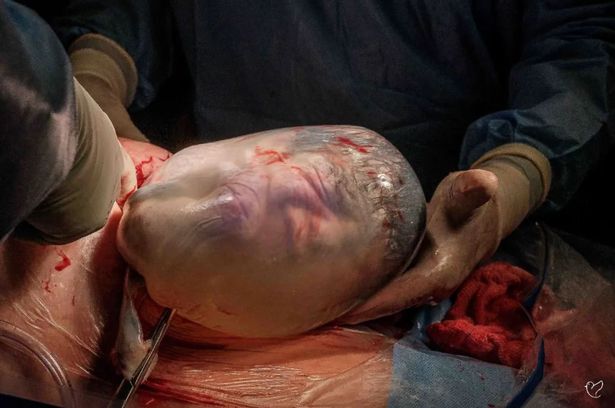 Astonishing photos show twin babies with one born inside intact amniotic sac