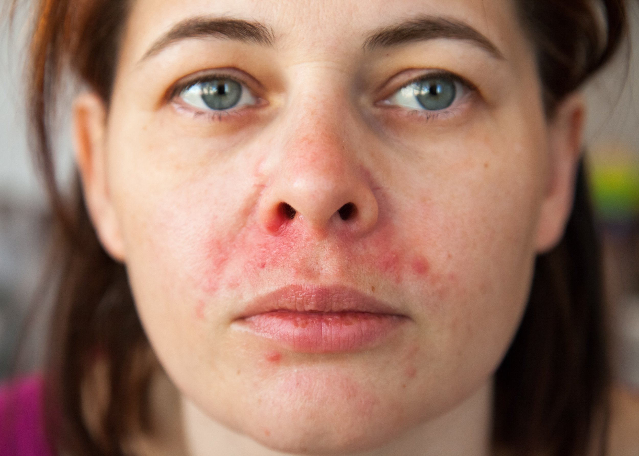 How to tell if your acne is actually this common skin condition