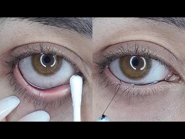Removing Long Eye Mucus Strings From Eye (Part 3)