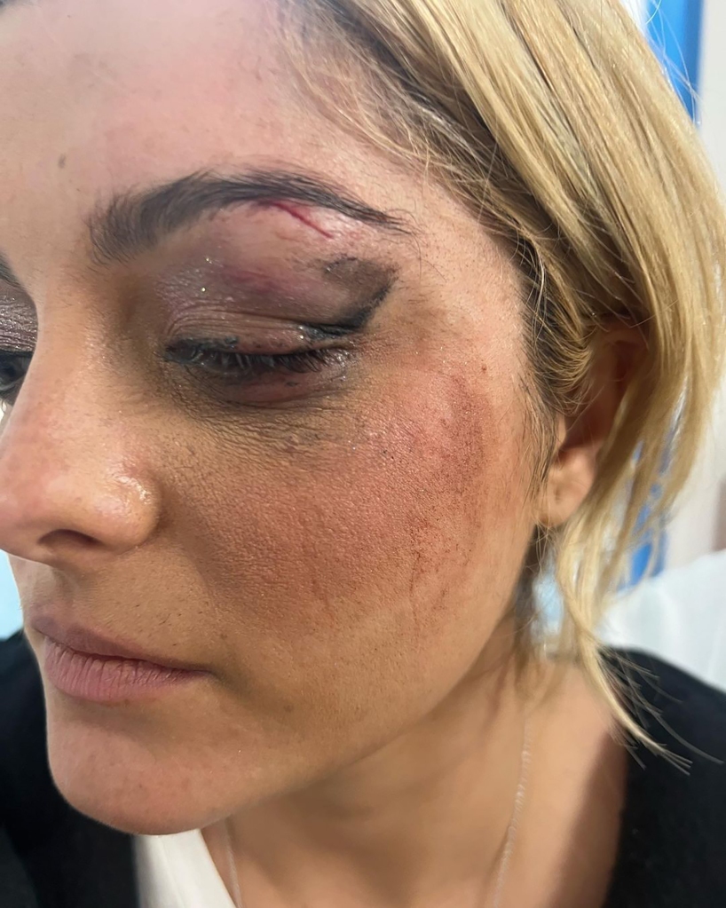 Bebe Rexha tells fans ‘no phones at my face’ in stage return after NYC assault left her with stitches