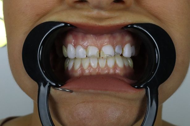 'My botched veneers left me housebound for THREE years - they crumbled in my mouth'