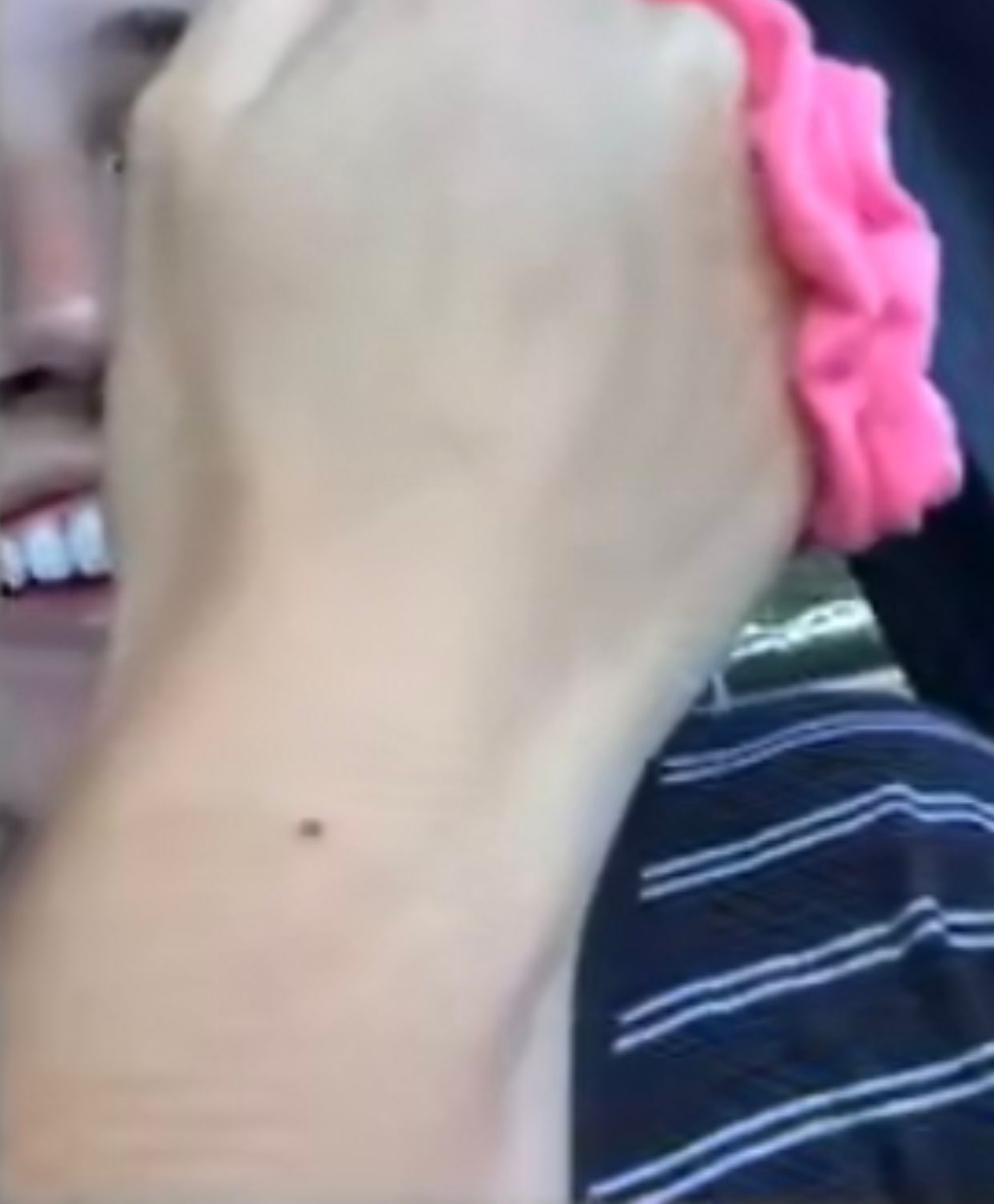 Why so many people seem to have the exact same freckle