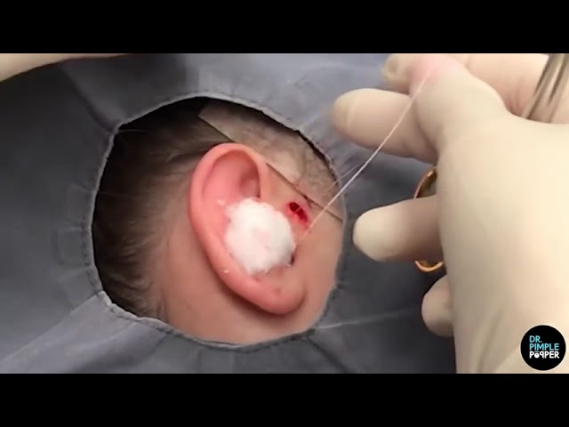 TMI! Accessory Tragus Removal