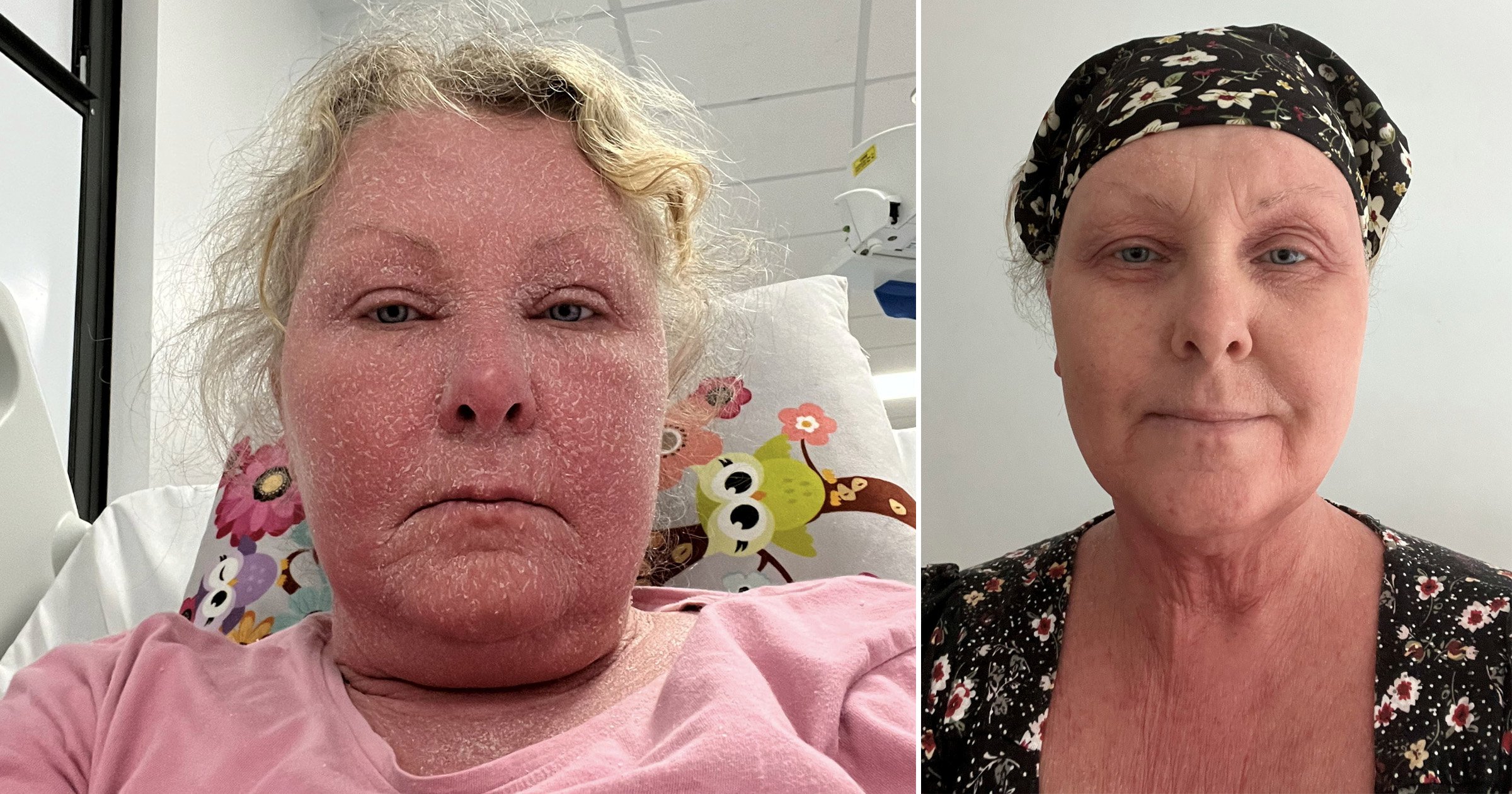 Woman loses all her hair and is forced to quit job after topical steroid withdrawal
