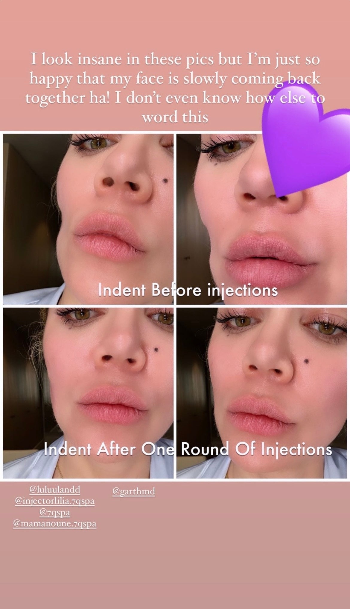 Khloé Kardashian Revealed the Indentation Left in Her Face by Skin Cancer Removal