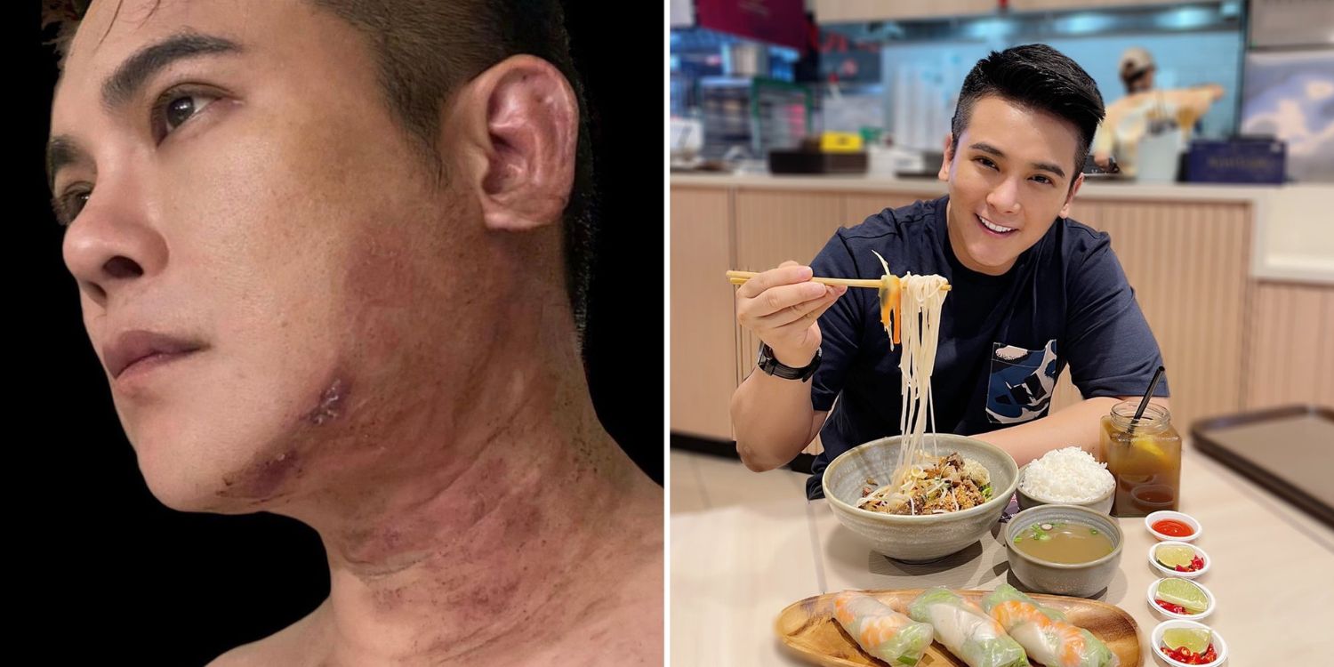 Former mediacorp actor nick shen battles ‘agonising’ shingles for 3 months, hospitalised with partial facial paralysis