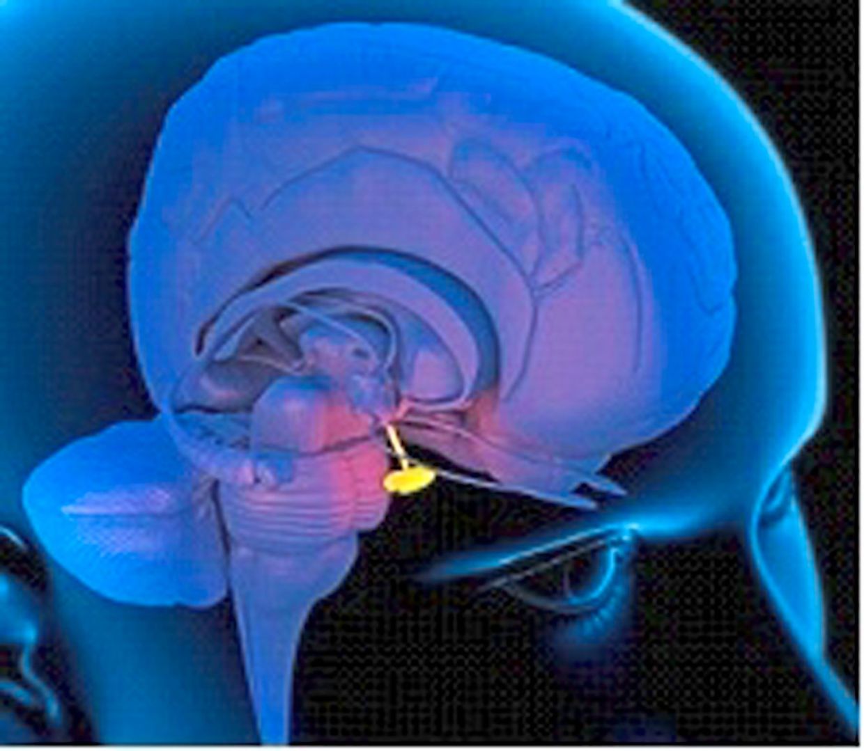 Cushing's syndrome occurs when there is too much cortisol