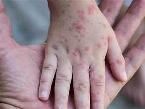 Five new monkeypox cases detected