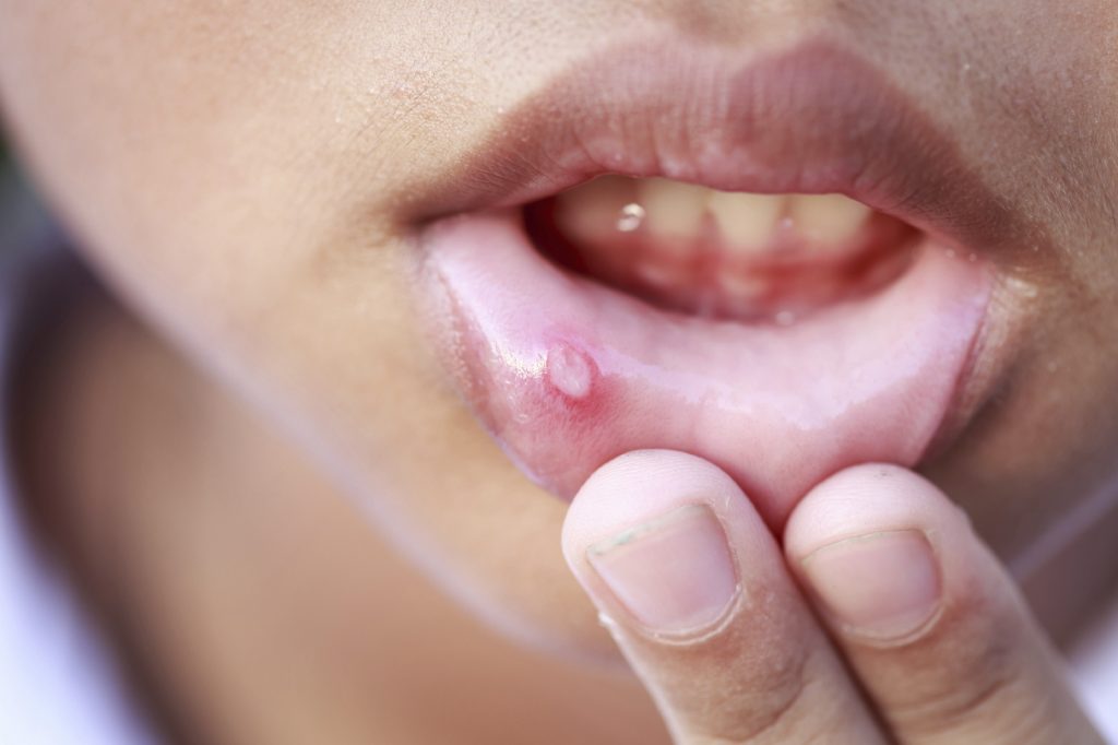 口腔溃疡不是小事！男子Ulcer「半年不会好」⚡竟罹患舌癌！这3大群体要注意！（内附症状~）