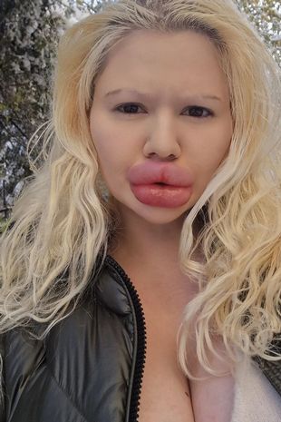 Woman with 'world's biggest lips' treats herself to more filler as a Christmas present