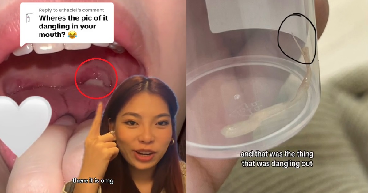 SG woman had taugeh stuck inside her throat, doctor stunned like vegetable