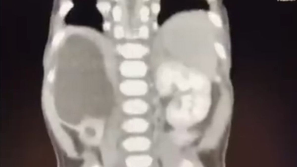Miracle baby born with four kidneys is one of less than 100 ever recorded in the world