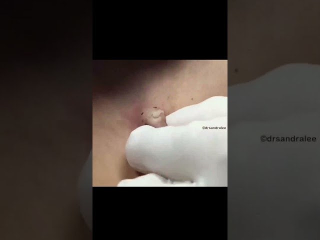 Here is an example of a cyst extraction using a Punch Excision Tool