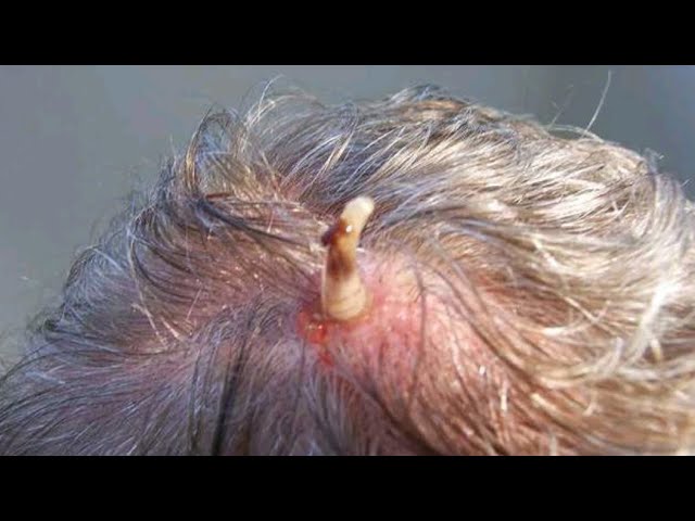 Removing A Massive Botfly Maggot From Kitten's Head (Part 3)