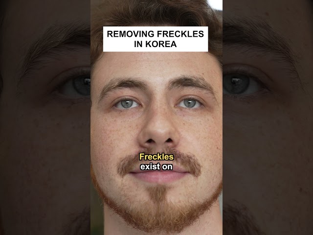 Removing Freckles in Korea #shorts