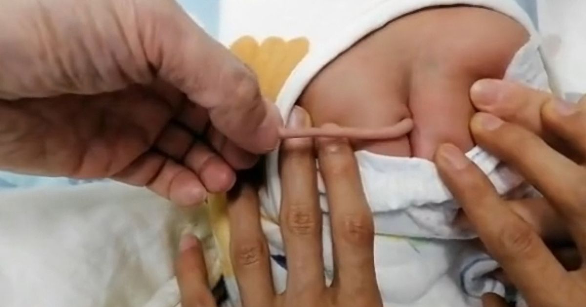 Baby born with four-inch tail growing from its back due to ultra rare birth defect