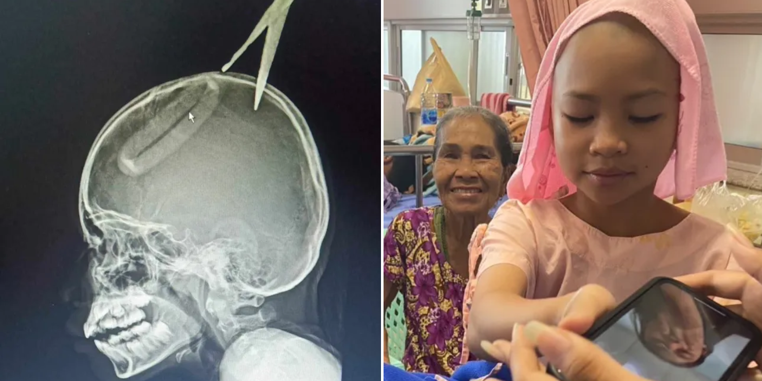 Scissors penetrate Thai Girl’s skull after 4-year-old brother throws them to imitate tv show