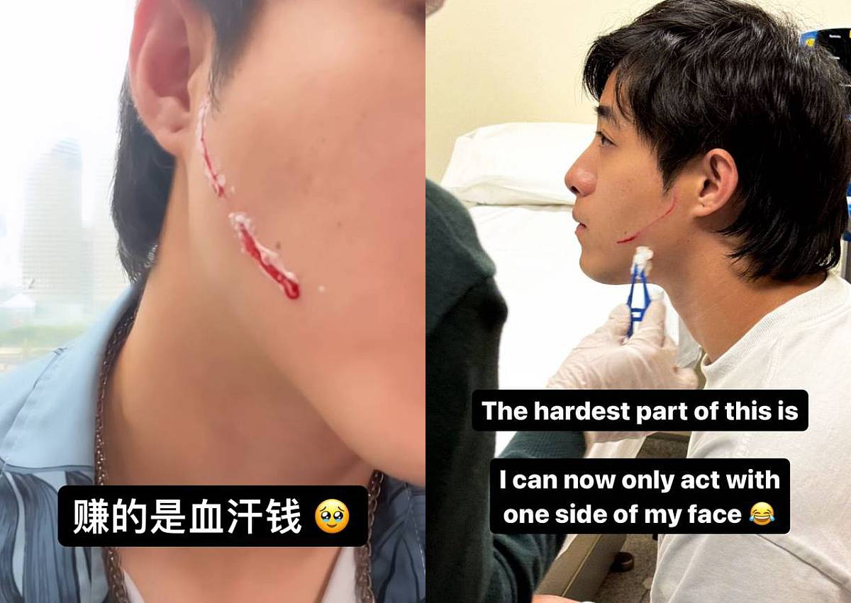 'My face felt hot': Zong Zijie suffers 10cm cut on cheek while filming drama