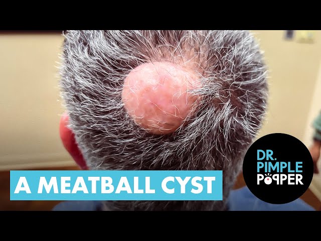 A Meatball Cyst