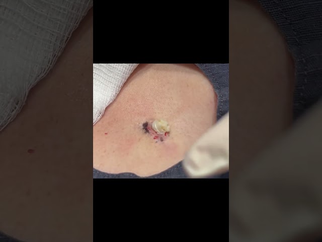 A Coconutcream Cyst on the Chest 🥥🥥