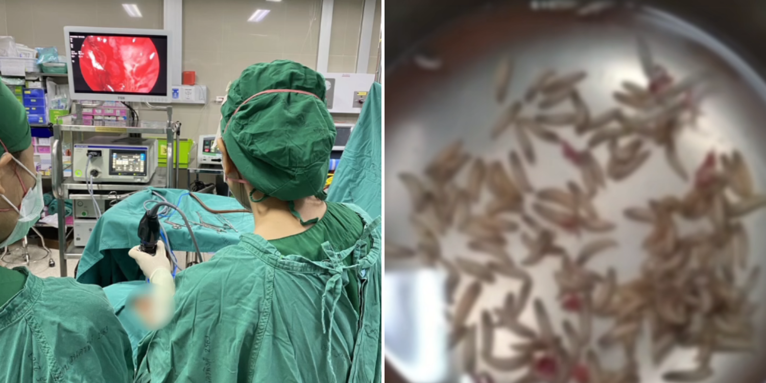 Woman with trouble breathing visits Thailand hospital, doctors find 100 maggots in nasal cavity