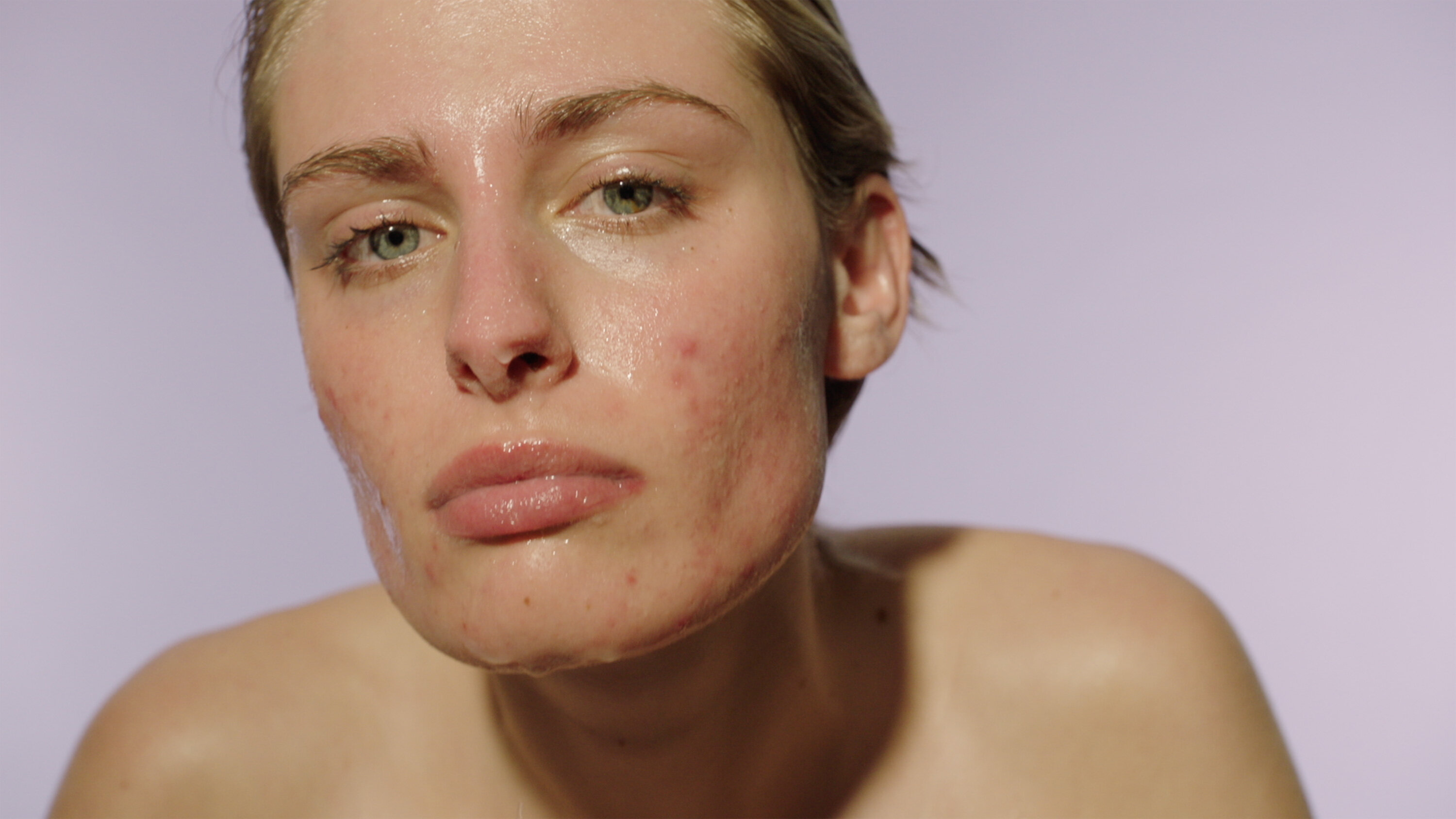 How to Build a Skin Care Routine for Adult Acne