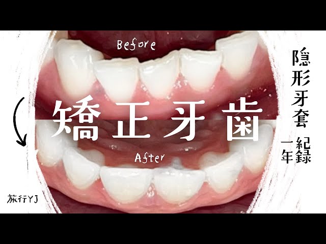 矫正牙齿 隐形牙套有用吗？花多少钱？一年配戴心得、ＱＡ 最详细攻略！【旅行YJ】