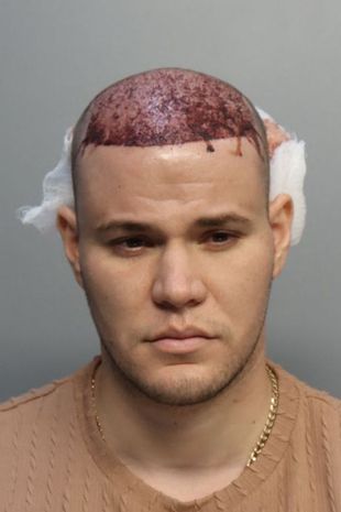 Man's hair transplant goes so wrong he's booted off flight as scalp began to leak