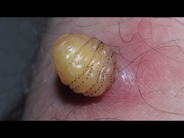 Removing Massive Cuterebra From Tiny Kitten's Neck (Part 80)