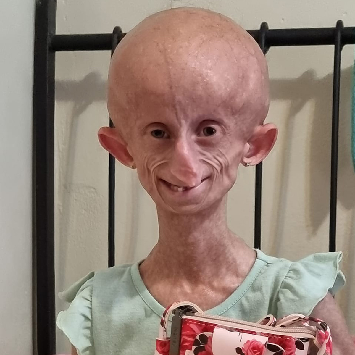 TikToker Beandri Booysen Dead at 19 After Battle With Rare Genetic Condition