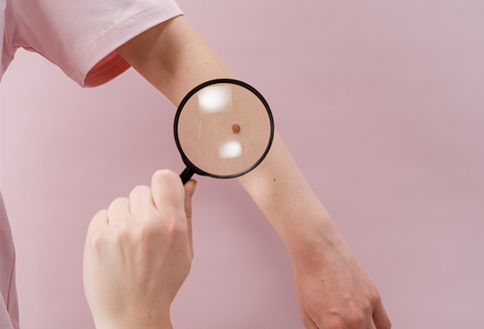 Mole Removal in Singapore: Top Clinics To Visit & Prices