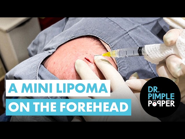 A Mini Lipoma on the Forehead